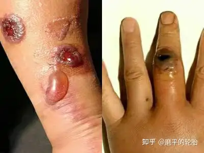 山西省文水县发生 9 例疑似皮肤炭疽疫情,病例已隔离治疗.