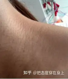 脖子鸡皮肤怎么解决