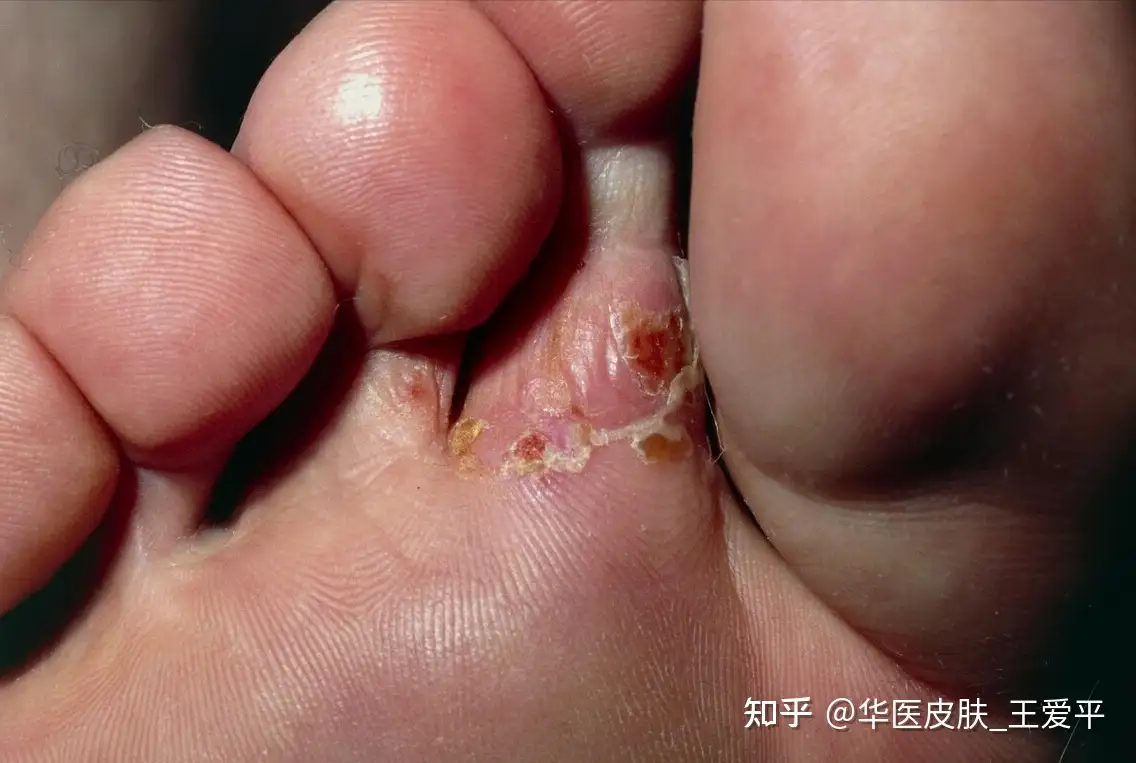 脚长皮癣怎么用药？四个方法告诉你- 知乎