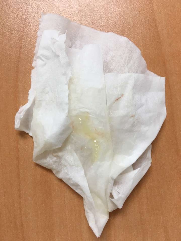 早上到下午大便三次,不稀,但最后一次我发现有果冻状便便并伴有血丝