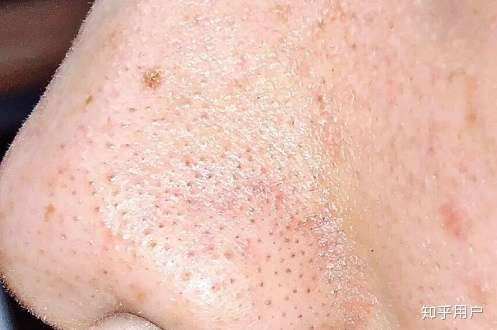 脸上有闭口和黑头要怎么解决?