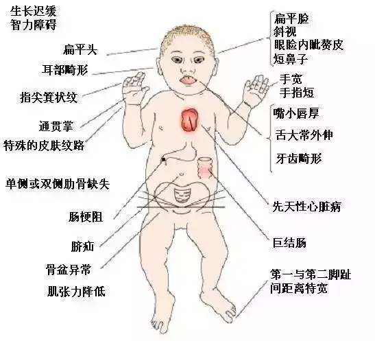 小儿痴呆面容图片图片