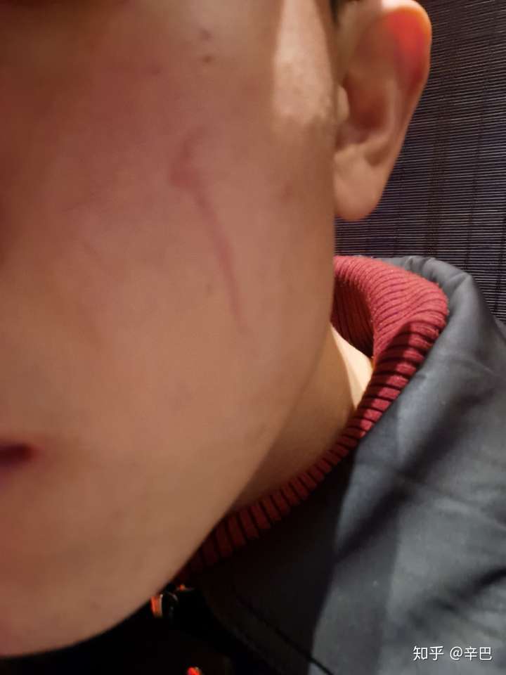 脸被指甲抓伤结痂掉之后有道红印怎么才