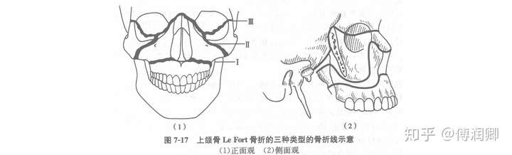 牙齿骨性龅牙正颌手术相当于人为断骨重新拼接以后万