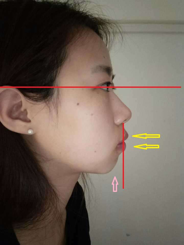 请问大家我是牙凸还是缺下巴,还是两者都有,现在如果急需矫正的话,是