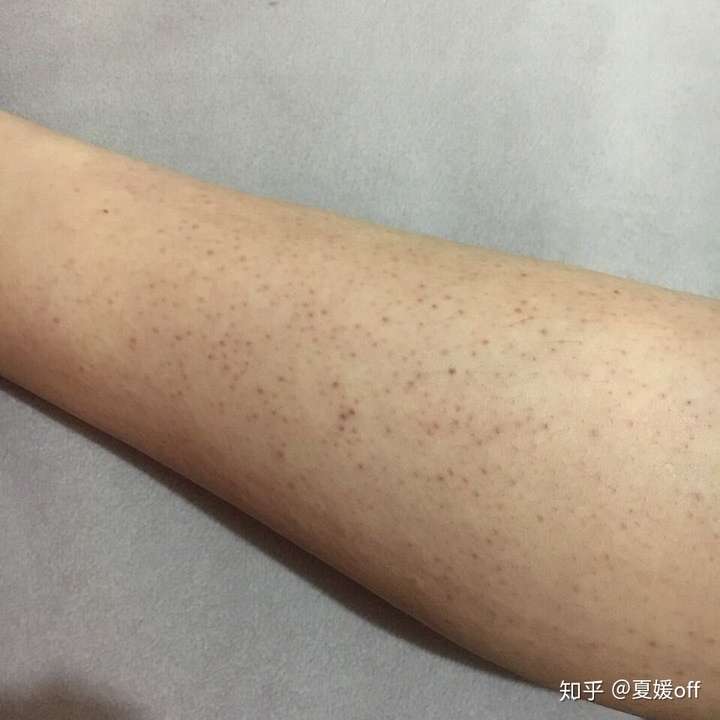 鸡皮肤可以用按摩霜(鸡皮肤可以用按摩霜吗)