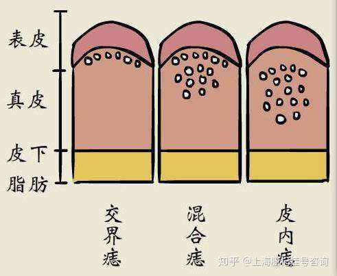 孩子手臂上的黑色胎记长毛了怎么办