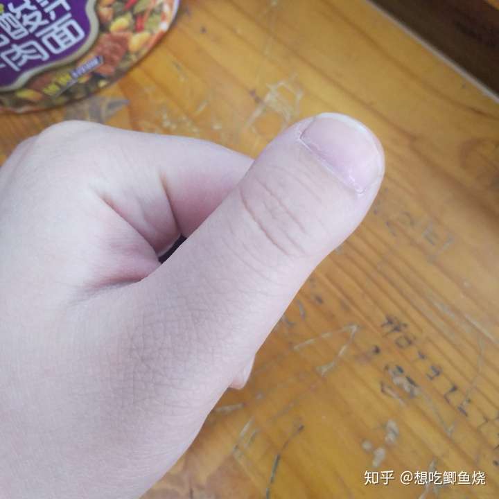 为什么我的大拇指又宽又短?