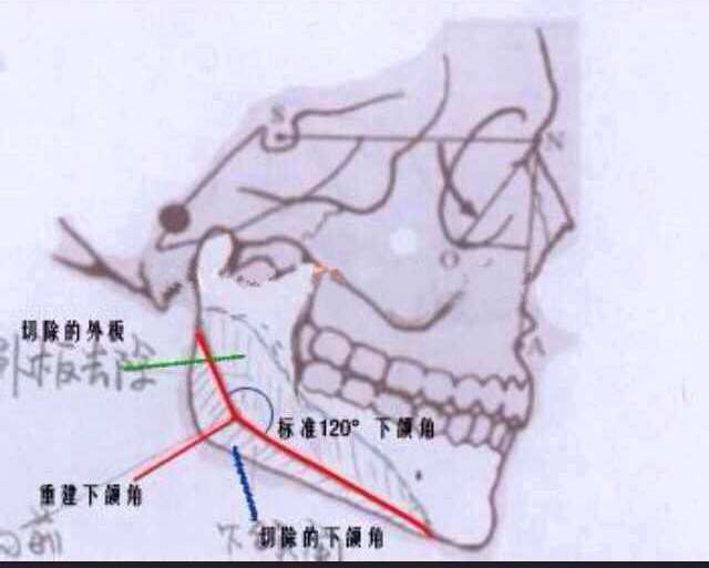 下颌角再造式切法 下颌角案例