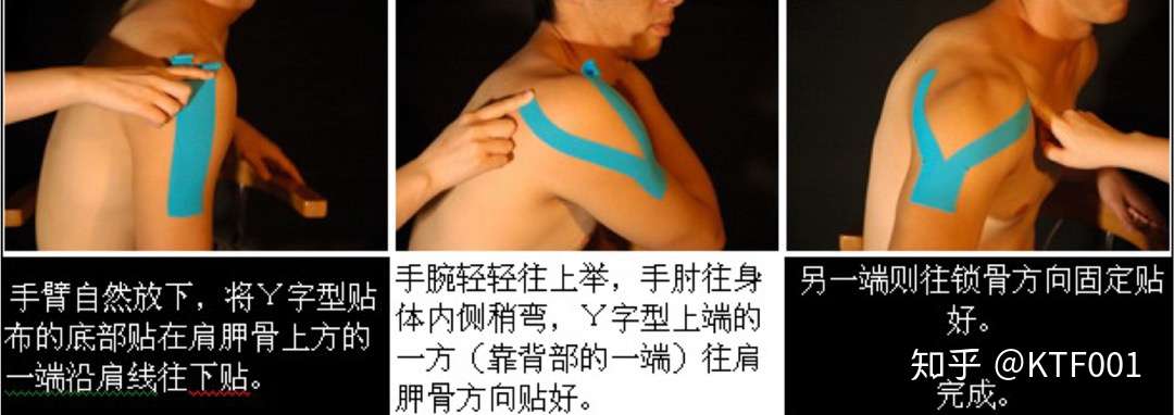 肌内效贴布缓解疼痛小妙招 知乎