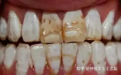 牙齿越变越黑专家分析或是这些原因引起要变白可以这么做