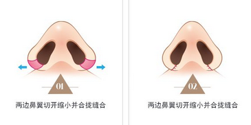 鼻翼很大该选用哪一种鼻翼缩小术内切还是外切