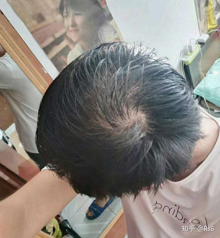 脱发- 知乎