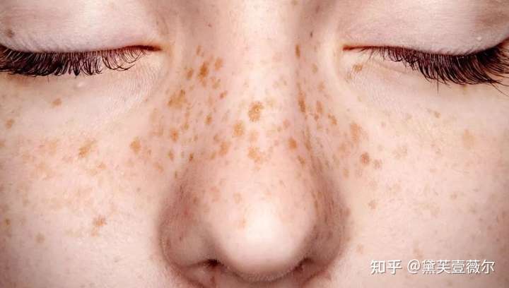 女人肌肤的致命杀手就是斑点,你是否也是被脸上的色斑所困扰,原本白白