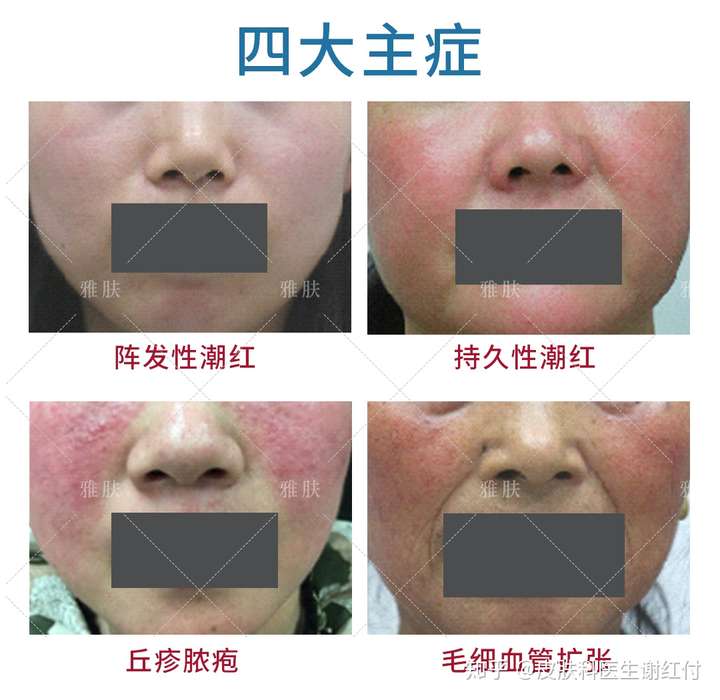 "玫瑰脸"和"激素脸"傻傻分不清,难怪你的皮肤敏感总不好