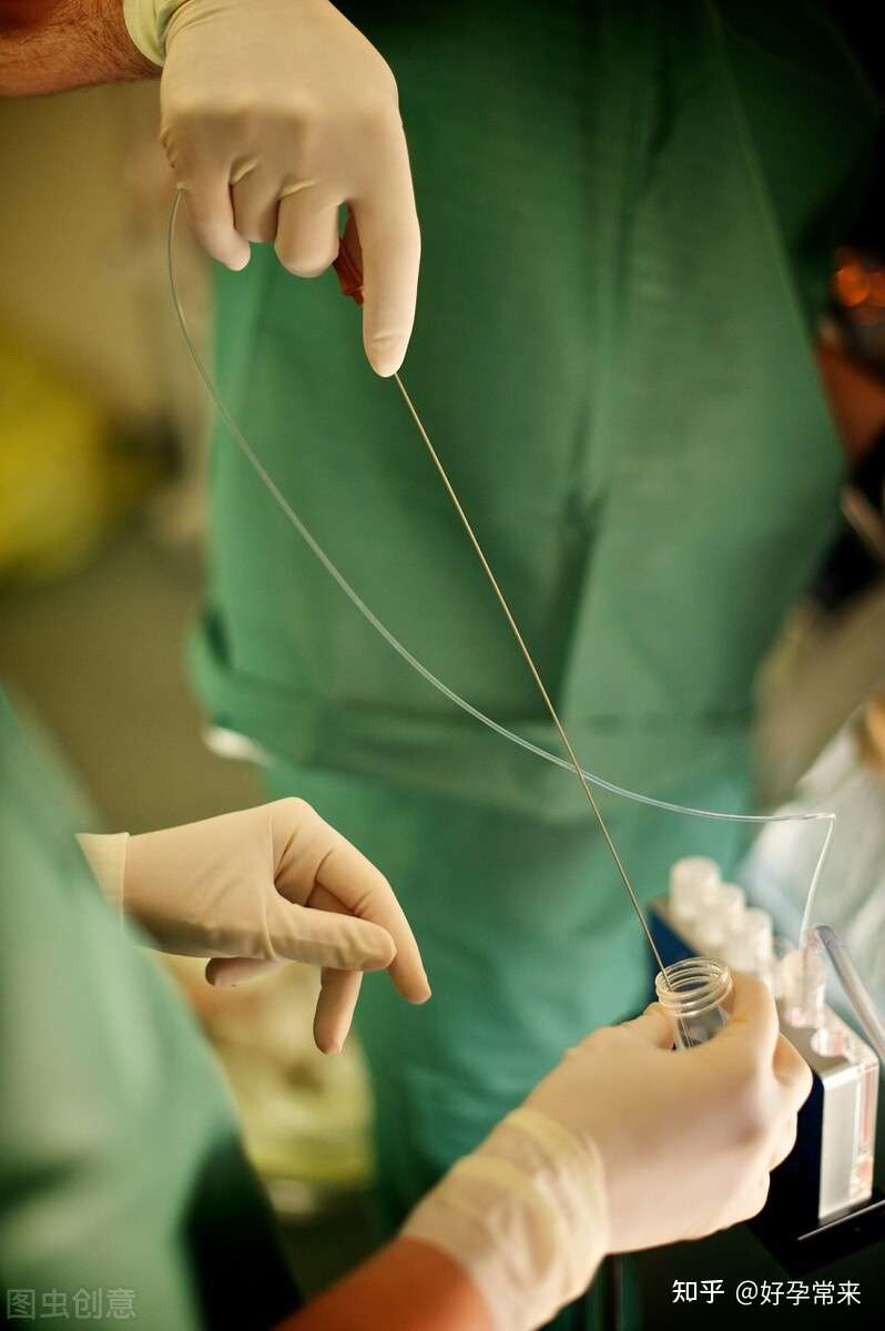 好孕常来 的想法: 试管取卵是如何进行的,会有疼痛感吗? … - 知乎