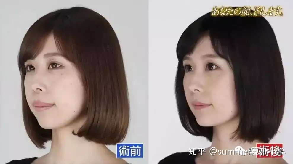 龅牙大长脸的明星姐姐出道被骂太丑 因为自卑两次整容变仙女 知乎