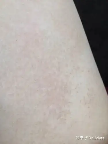 有没有姐妹也和我一样呜呜大腿内侧黑色素沉淀比较严重啊唉