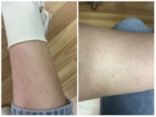 关于鸡皮肤者请看过来吉他的信息