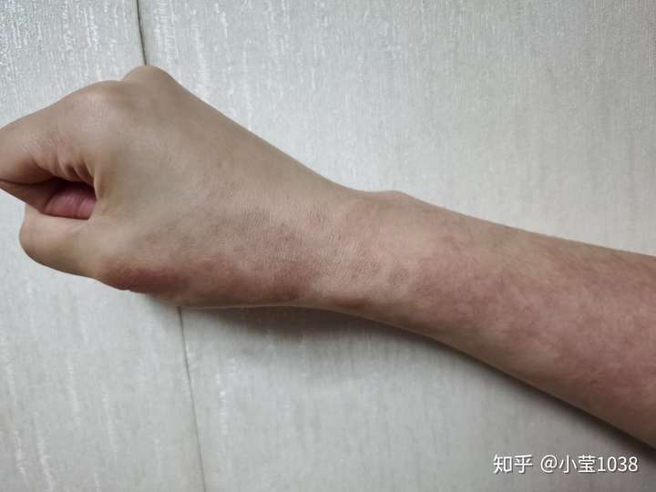 鲜红斑痣光动力治疗记