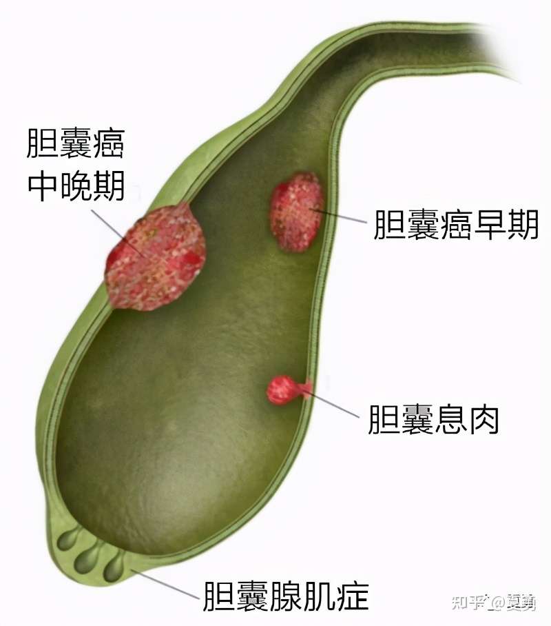 癌症 王中王 胆囊癌怎么办 知乎