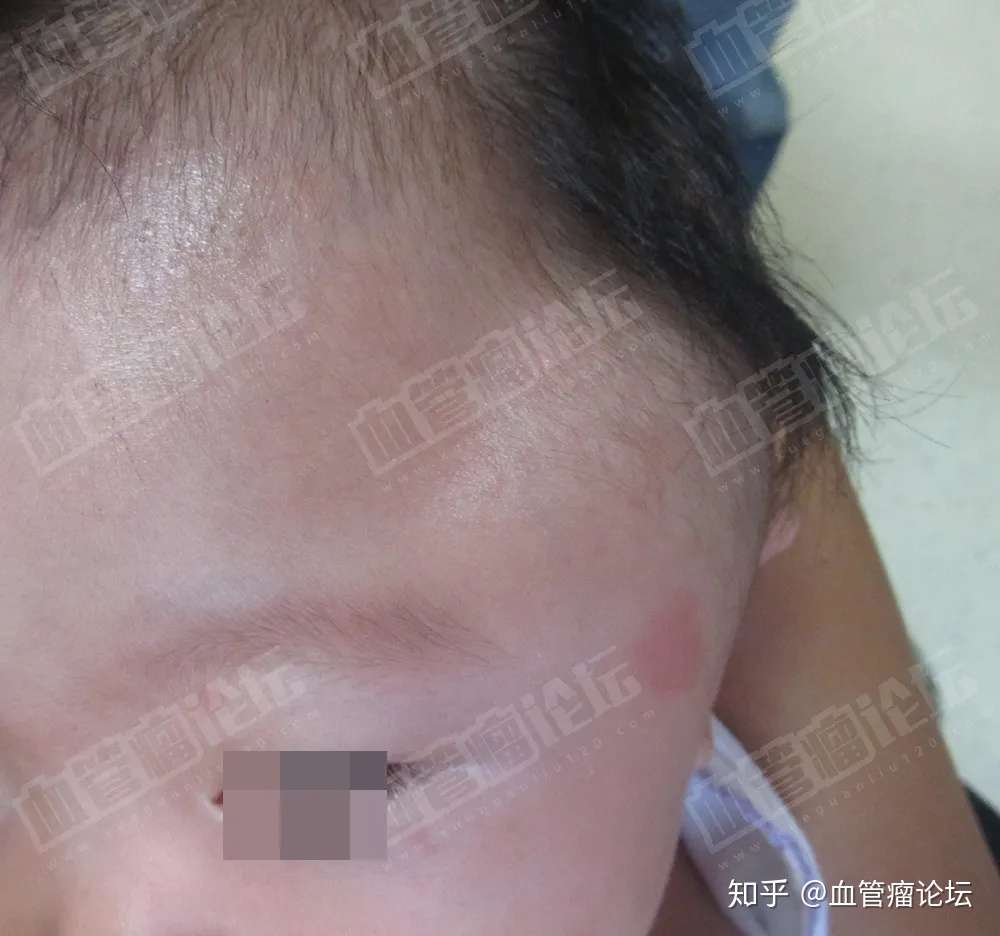 孩子太阳穴长有血管瘤 导致太阳穴凸起 头部变形 情况危急 知乎