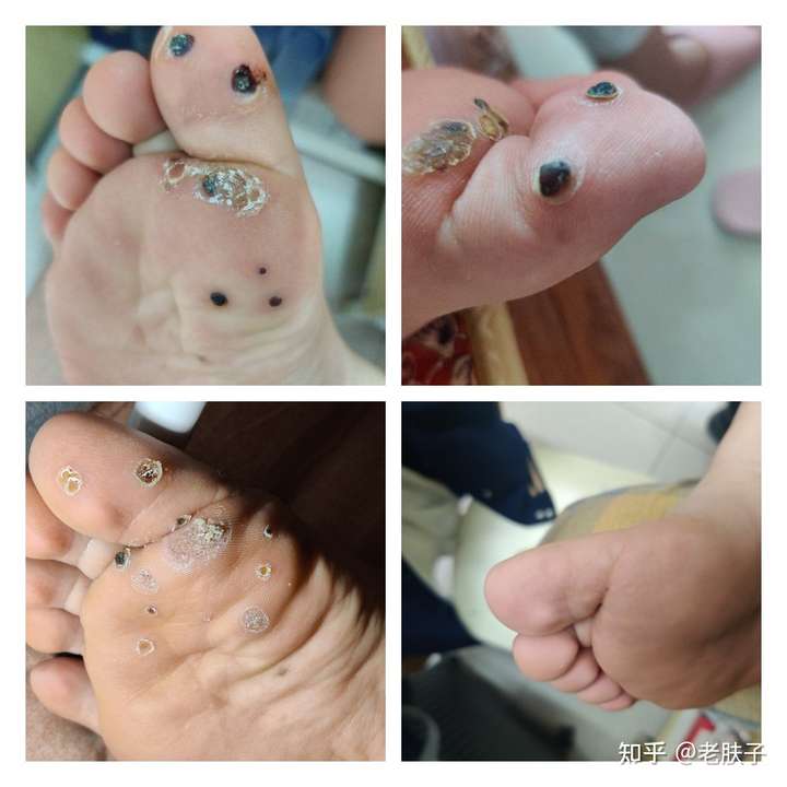跖疣怎么能治好呀,大家都用什么方法,求告知呀!
