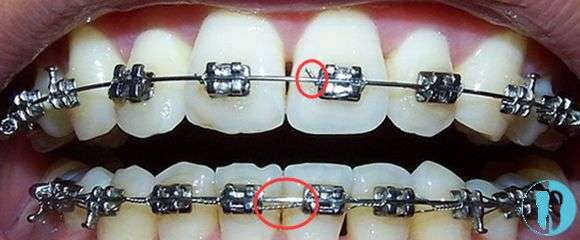 方法②金属自锁托槽矫正——价位大概在9000元~15000元左右.