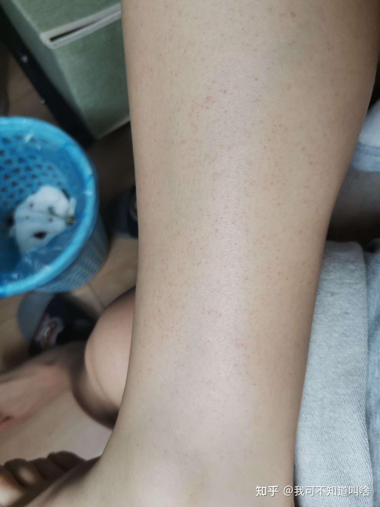 请问这种小的皮下出血点是怎么回事呢 知乎