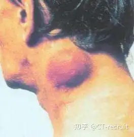 非霍奇金b细胞淋巴瘤好治吗?治疗有什么好的方案吗?