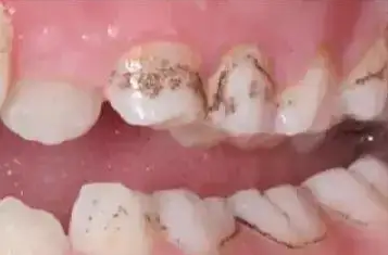 孩子牙齿有黑黑的东西是什么？