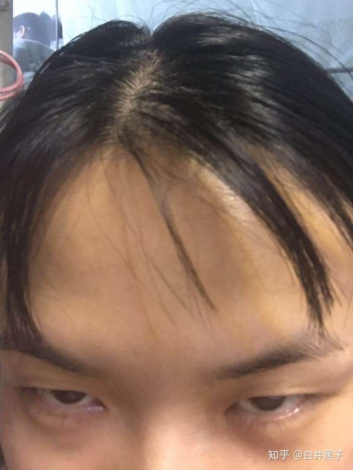 网红刘海剪失败了怎么办