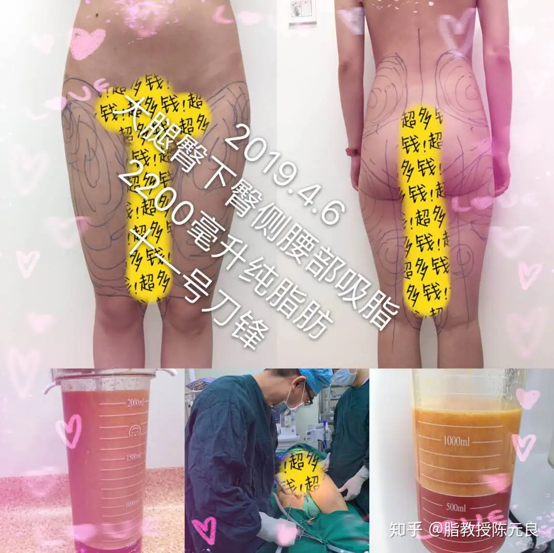 刀锋---抽脂塑身】脂肪抽吸量的评估- 知乎