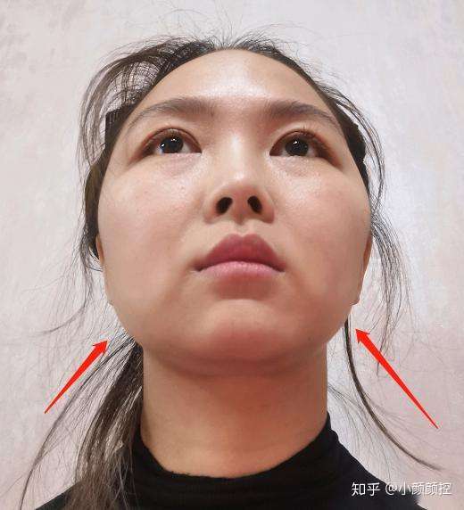 两边咬肌不一样大导致两边脸不一样有什么方法能弄对称吗