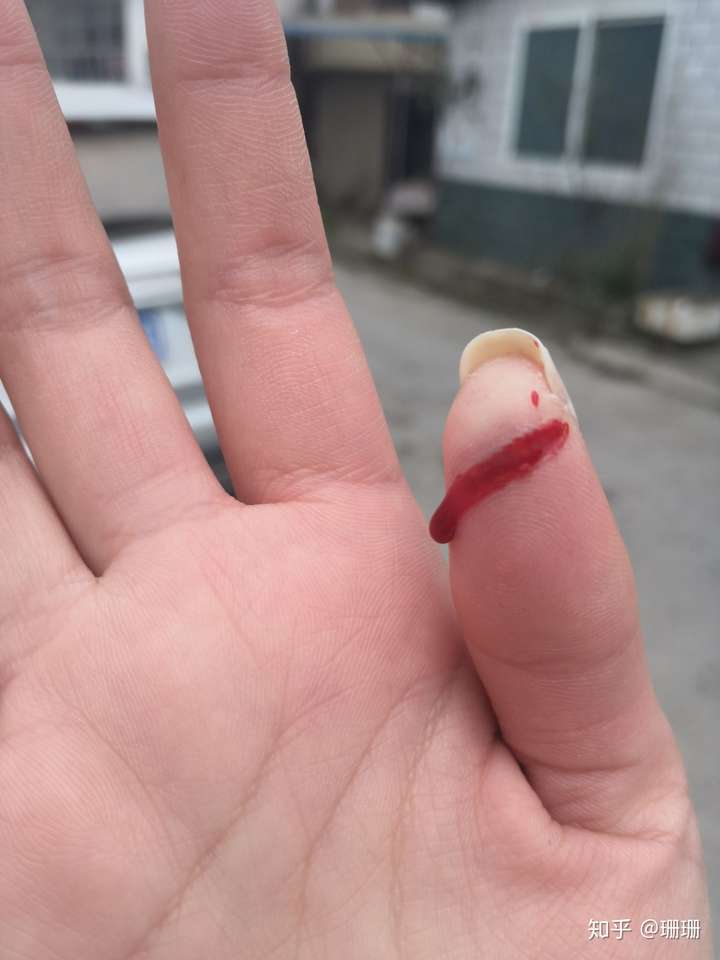 手被车门夹了怎么办?