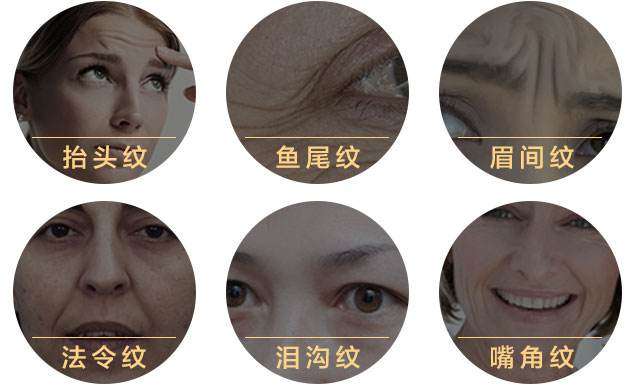 萎缩皱纹是指出现在稀薄,易折裂和干燥皮肤上的皱纹,如眼部周围那些无