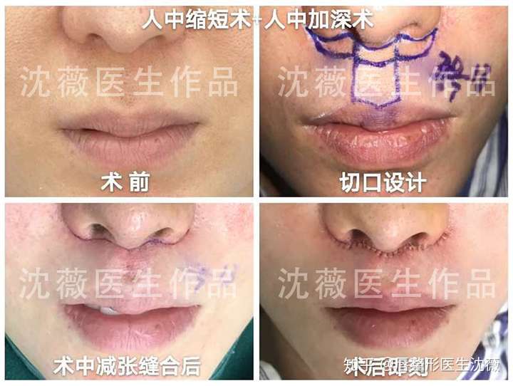 人中沟如何才能变深?