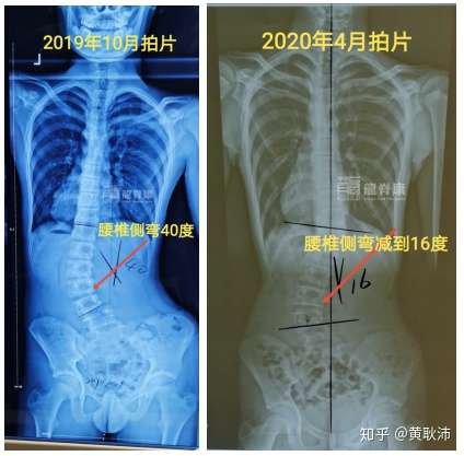 体态异常,于是2019年10月份带孩子到外院拍片检查,确诊脊柱侧弯已经