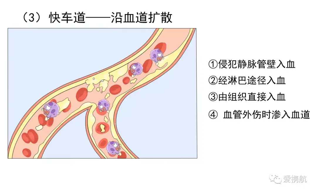 乳腺癌的转移过程 别不重视 知乎