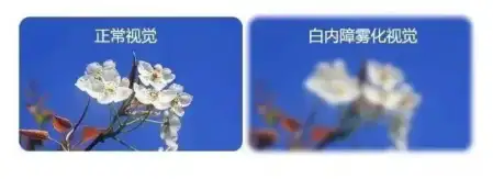 什么是白内障，怎么治疗白内障？