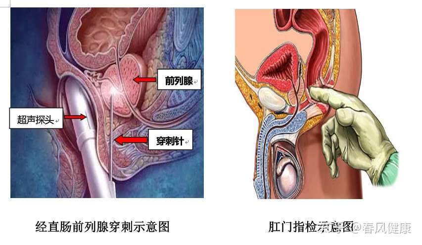 危机四伏 这些因素都会影响psa值 知乎