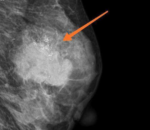 乳腺钼靶和彩超的区别是什么？