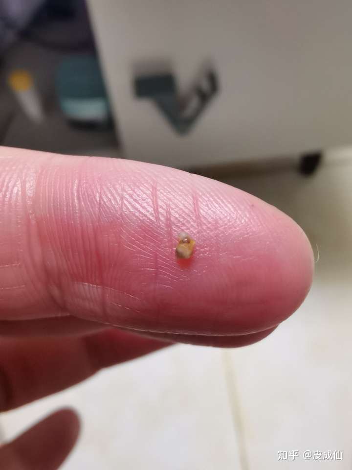 你见过最大的黑头有多大?