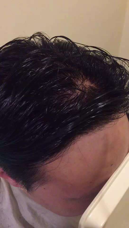 重庆植发补发(重庆植发一般多少钱)
