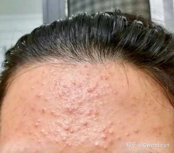 正在向开口粉刺转化的过程