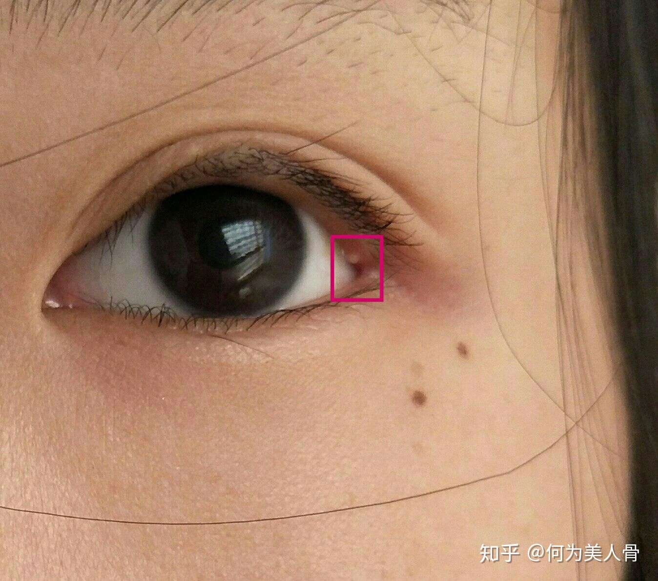 麦粒肿 知乎