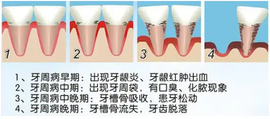 牙周病怎么治疗？大家都有什么方法可治疗牙周病？