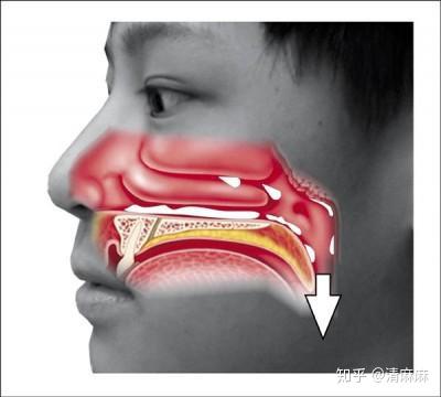 鼻屎是怎么形成的图片