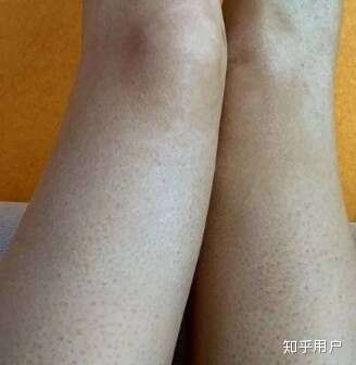 跑完步全身是鸡皮疙瘩(运动完浑身起鸡皮疙瘩咋回事)