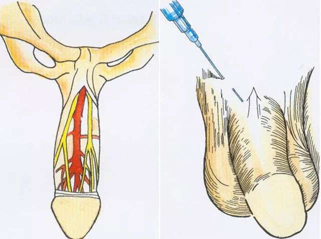 自行阴囊注射麻醉剂图片